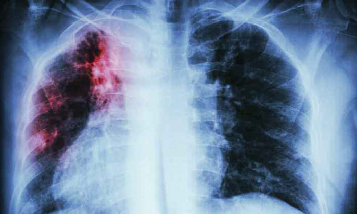 Tuberculosis  from Dr Parthiv Shah